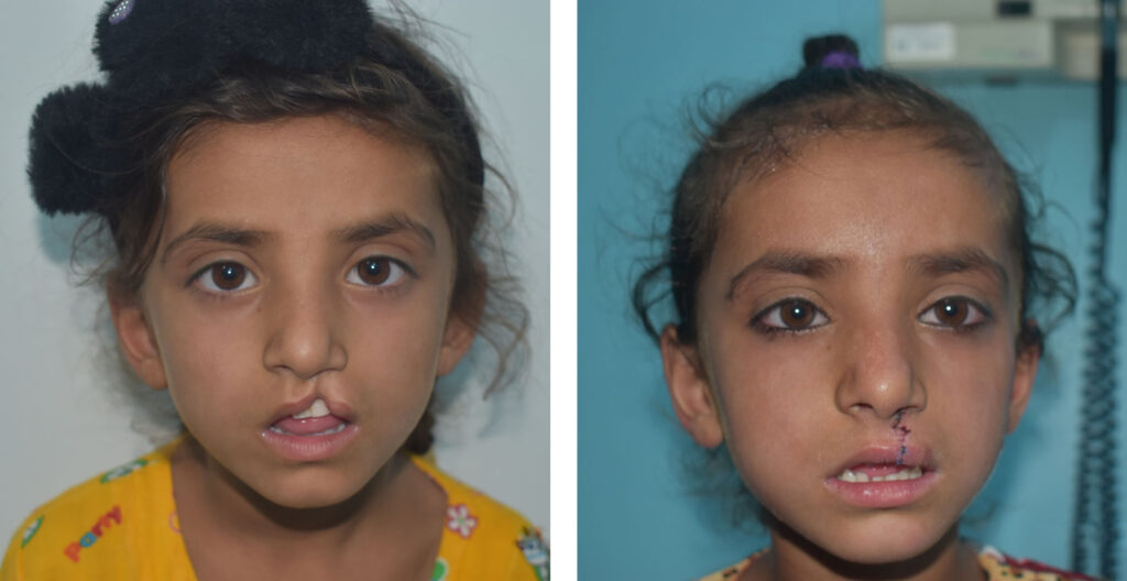 Safia before and after cleft repair