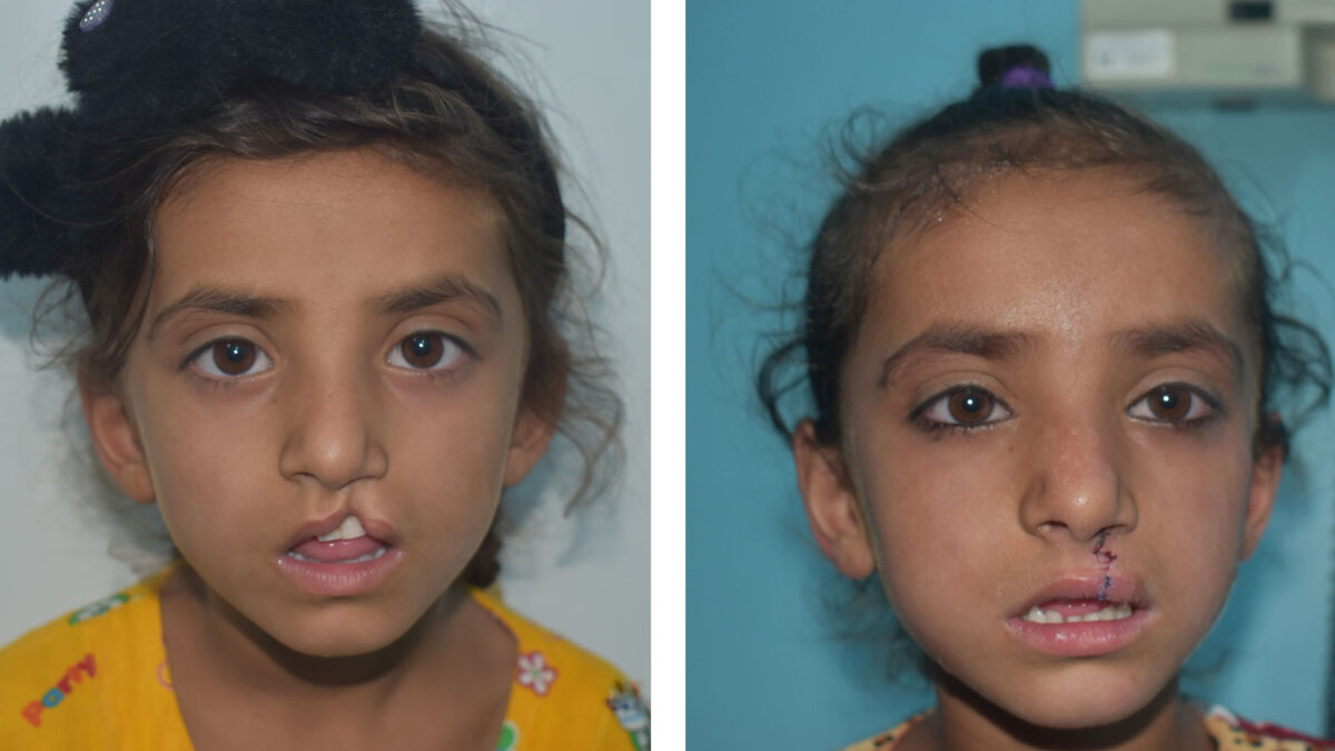 Safia before and after cleft repair