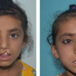 Safia before and after cleft repair