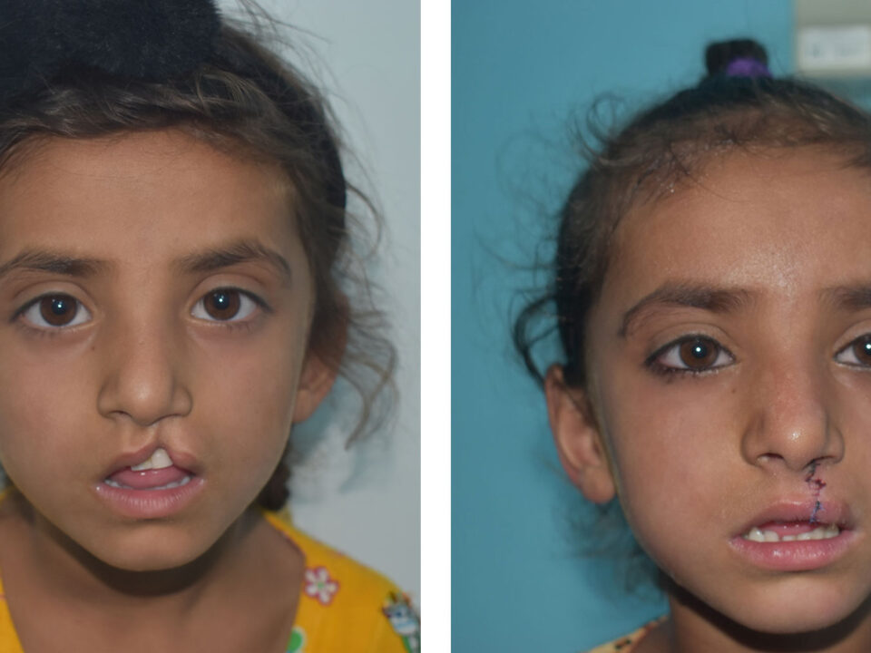 Safia before and after cleft repair