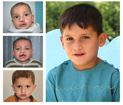 Afghan boy Qasim before and after cleft lip and palate surgery at Cure Hospital in Kabul, Afghanistan - four photos from age six months to healthy young child